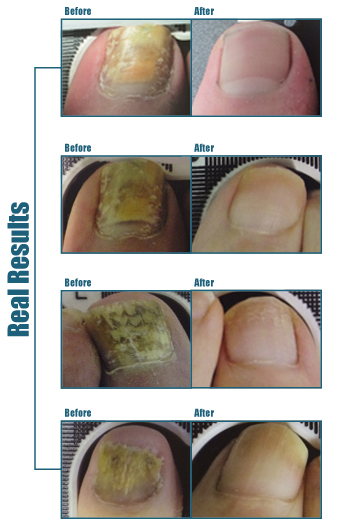 before and after toenail fungus treatment with Lunula Laser