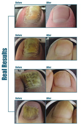 Lunula Cold Laser Fungal Nail Therapy - Footpoint Podiatry