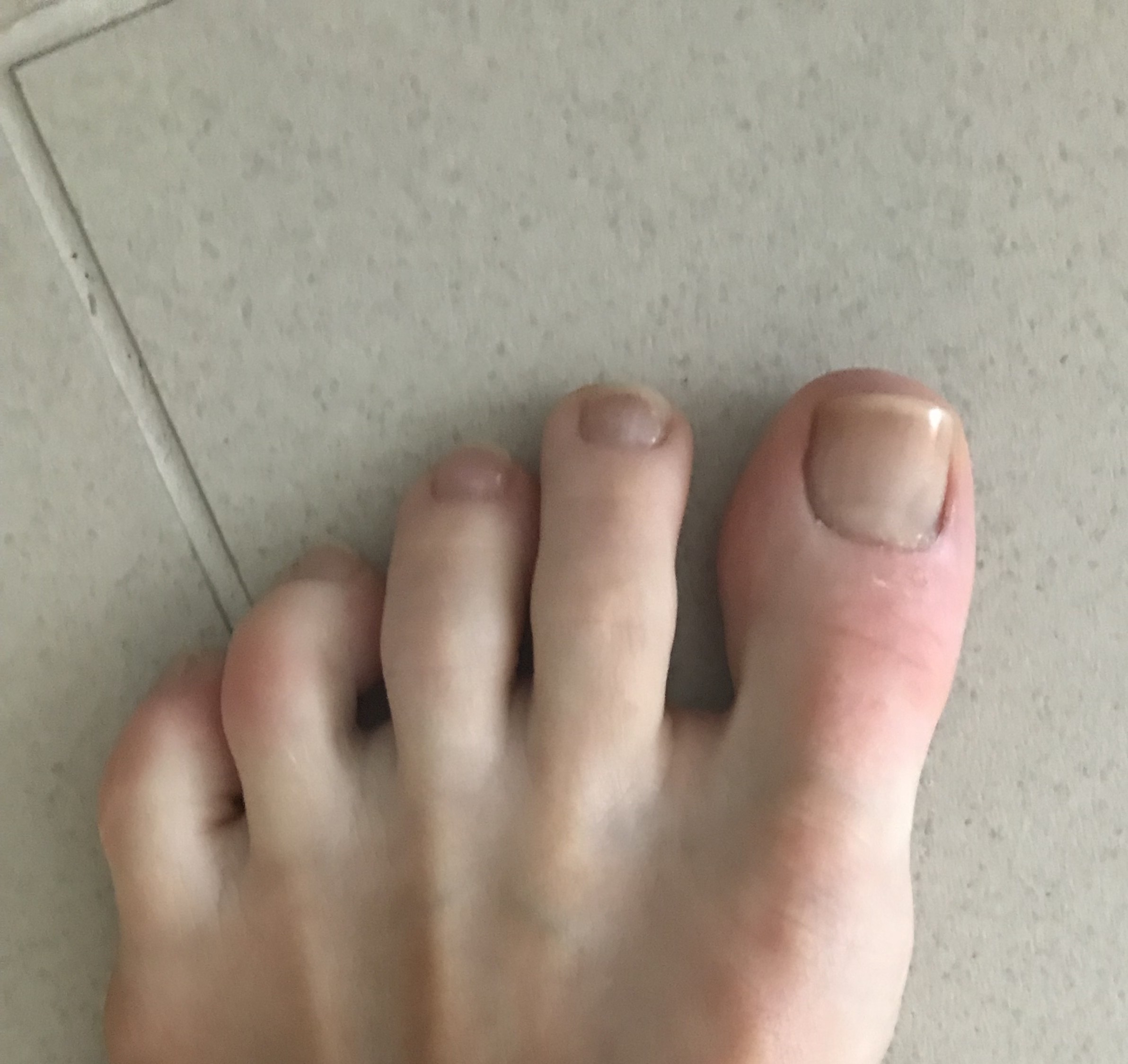 Fungal Nails: See some real results - Footpoint Podiatry
